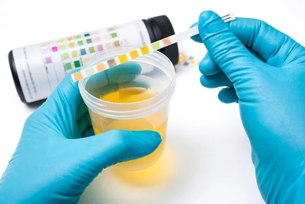 Urine Test