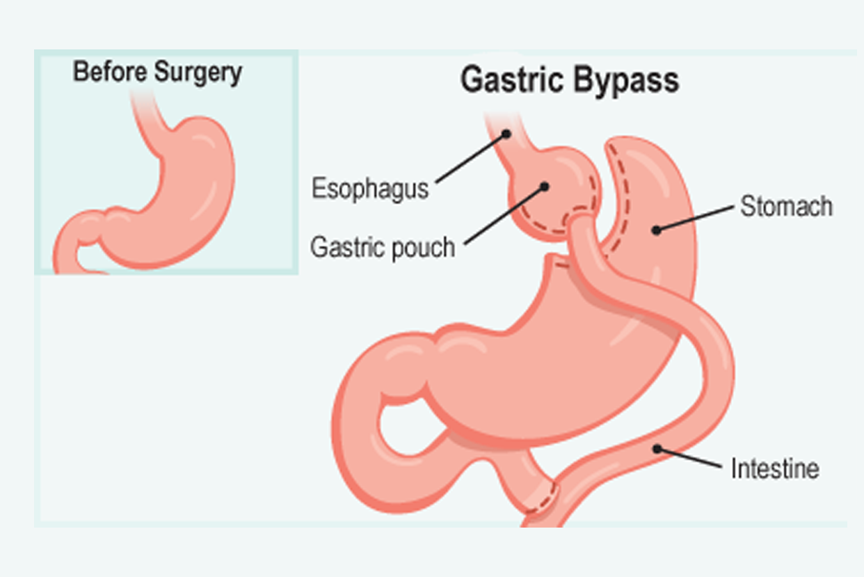 Bariatric Surgery