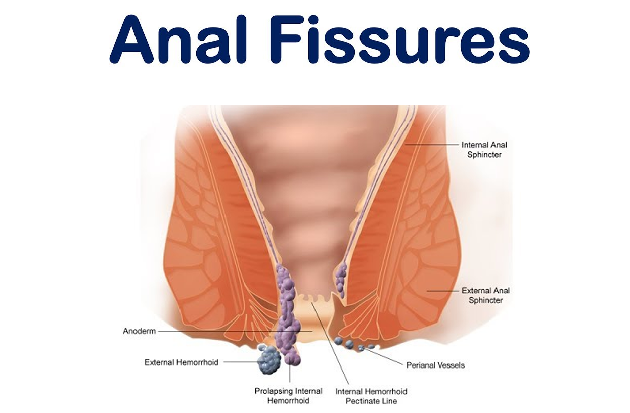 Anal Fissure