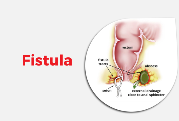 Anal Fistula Surgery